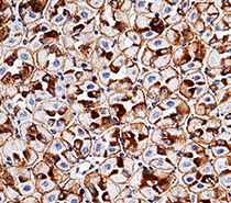 ADC target antigens in solid tumors