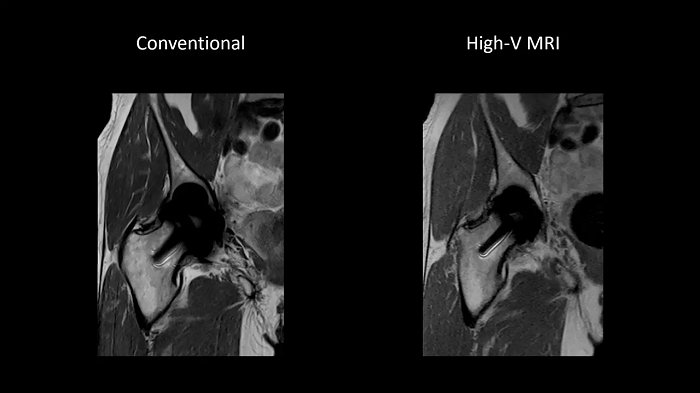 80 cm bore MAGNETOM Free.Max
