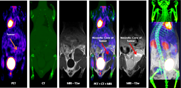 Multimodal Imaging: Multimodal imaging combines the strength of MRI with other imaging modalities such as PET and CT. PET provides information on the spatial distribution of molecular signal of interest. In this case MRI confirmed that the absence of tracer uptake in the center of the images was due to the presence of a necrotic core, which appears hyperintense on T2-weighted MRI.