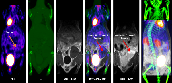 Multimodal imaging combines the strength of MRI with other imaging modalities such as PET and CT. PET provides information on the spatial distribution of molecular signal of interest. In this case MRI confirmed that the absence of tracer uptake in the center of the images was due to the presence of a necrotic core, which appears hyperintense on T2-weighted MR.