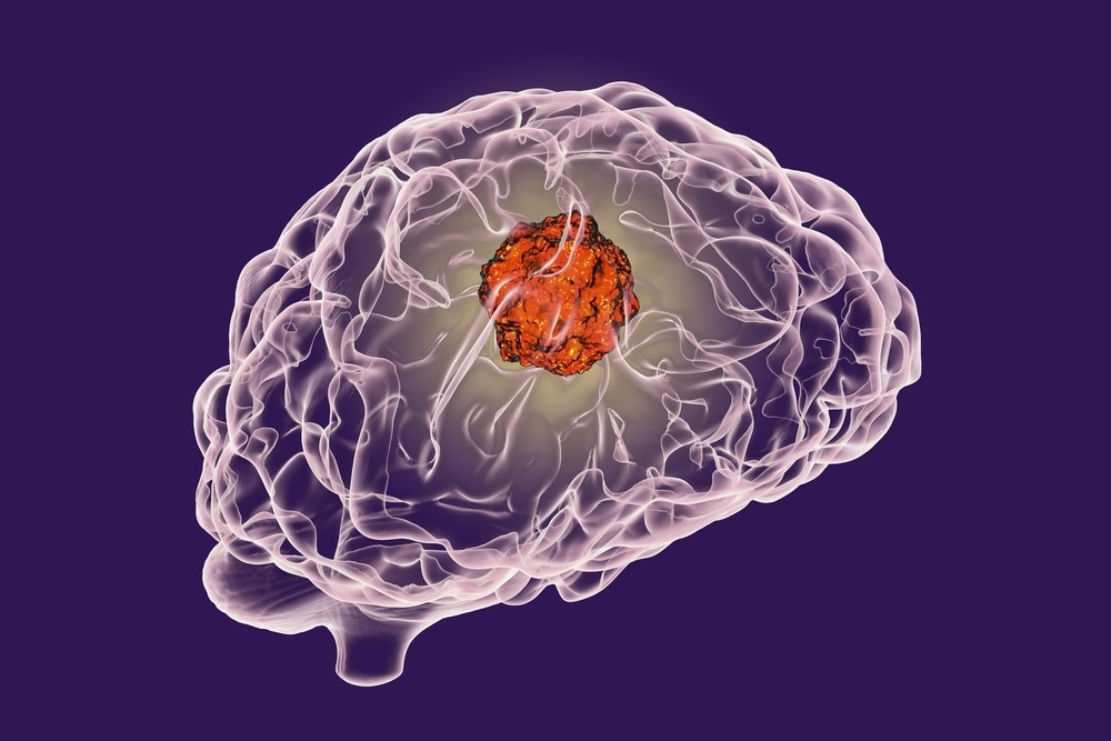 Image Credit: / Shutterstock.com brain tumor