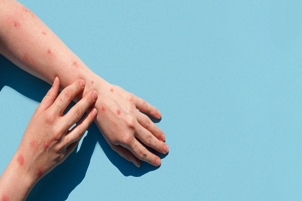 Study: The relevance of multiple clinical specimens in the diagnosis of monkeypox virus, Spain, June 2022. Image Credit: Marina Demidiuk/Shutterstock