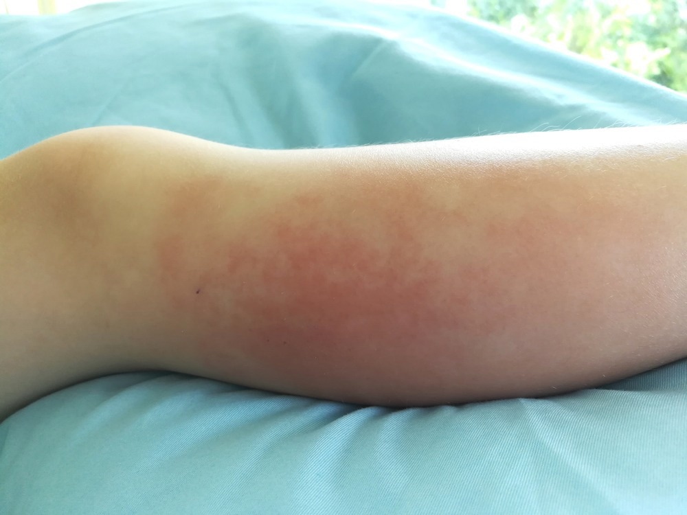 Study: Monkeypox infection and bacterial cellulitis: a complication to look for. Image Credit: DonyaHHI/Shutterstock