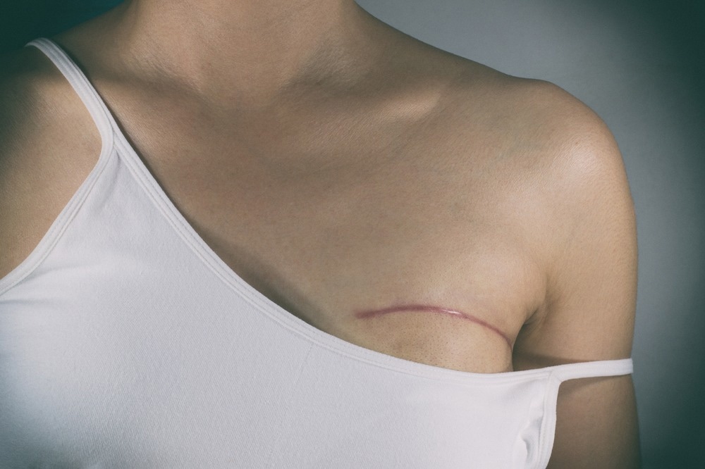 Study: Eliminating breast surgery for invasive breast cancer in exceptional responders to neoadjuvant systemic therapy: a multicentre, single-arm, phase 2 trial. Image Credit: Pradit.Ph / Shutterstock.com