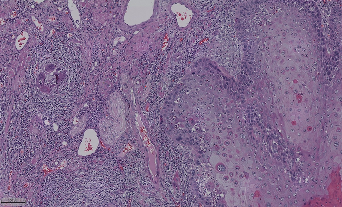 The team created a standardized metric for nerve density to clarify the variation in distribution of nerves in the oral cavity, called normalized nerve density, and showed its importance in tumor progression. Image Credit: Cindy Perez-Pacheco