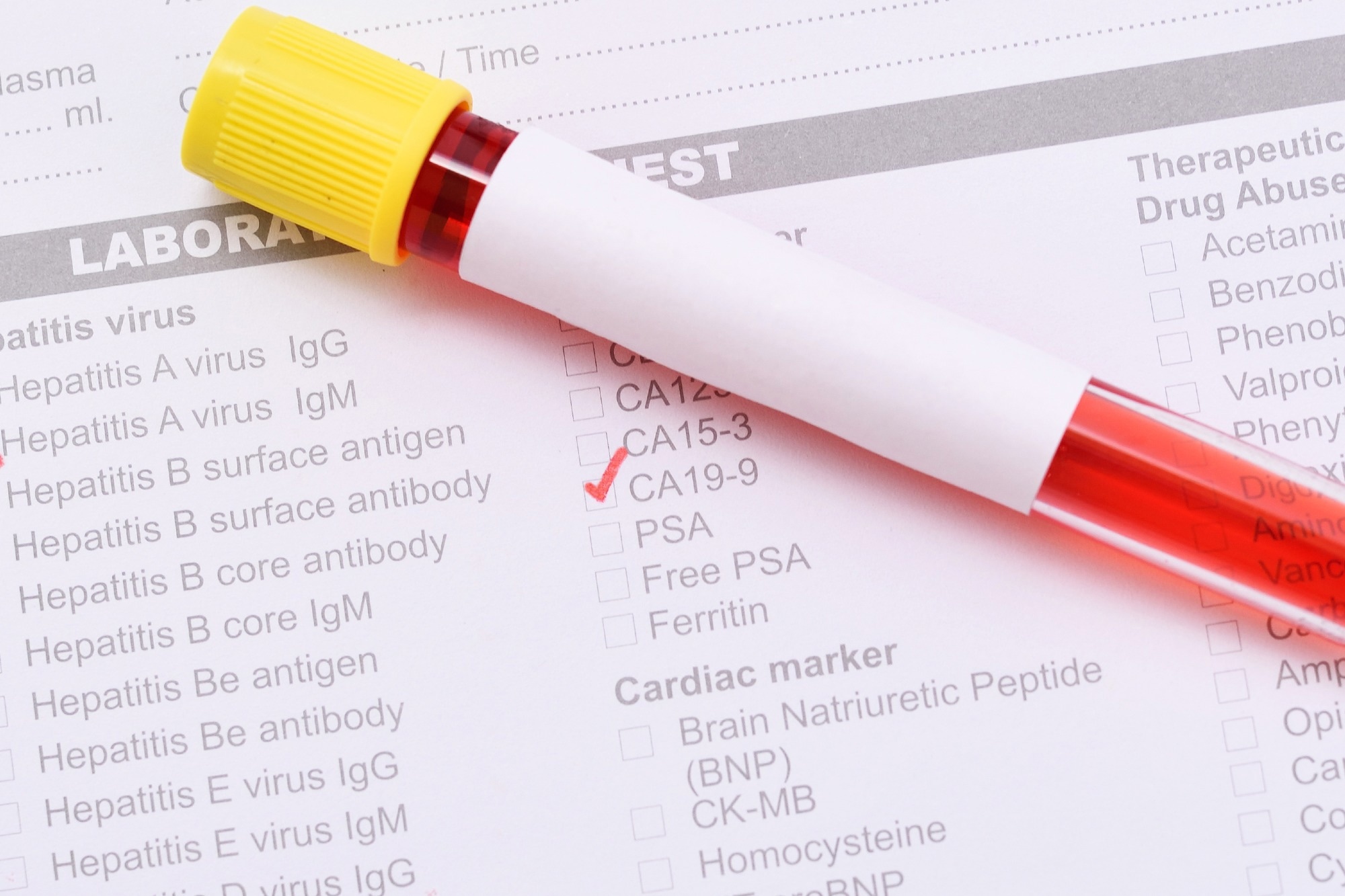 Prognostic Value of Routine Biomarkers in the Early Stage of COVID-19