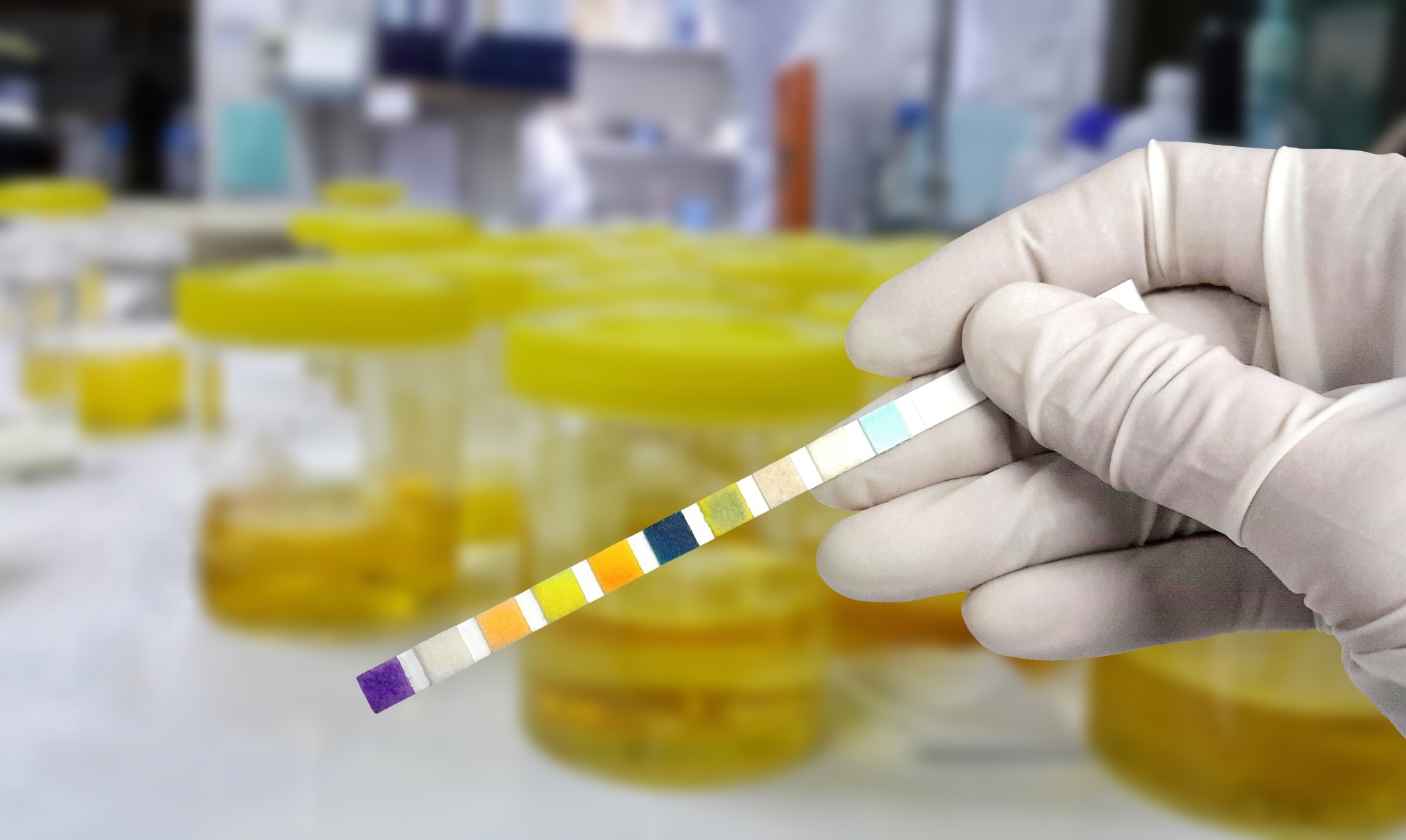 Study: Incidence of Pediatric Urinary Tract Infections Before and During the COVID-19 Pandemic. Image Credit: Chamaiporn Naprom / Shutterstock