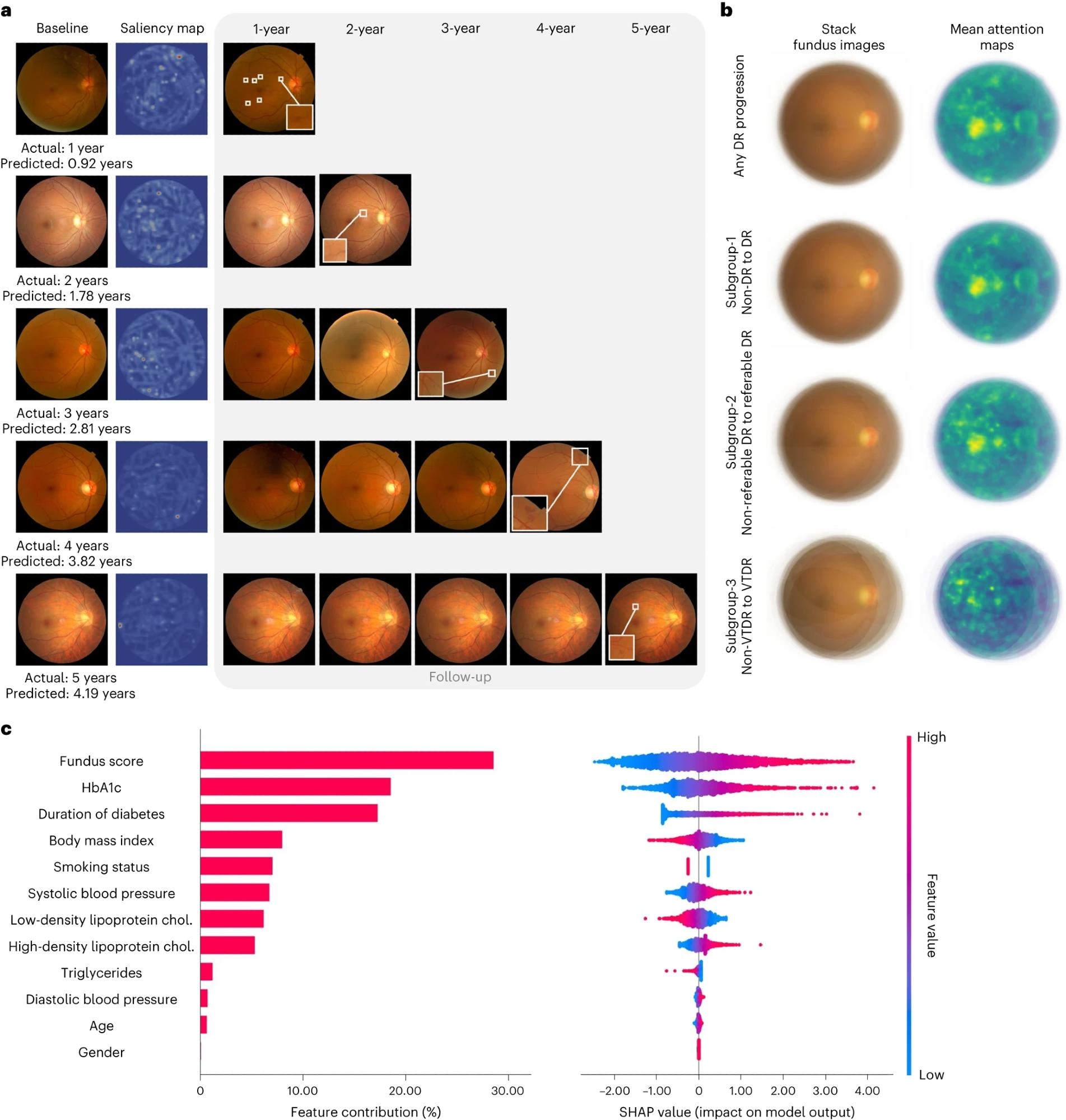 a, Comparisons of color fundus photographs at baseline and follow-up using attention maps. b, Mean attention maps and corresponding stack fundus images for any DR progression and subgroups 1–3. c, Bar plot (left) of fundus score and clinical features and their contribution to the prediction model of DR progression. Features are in descending order by contribution (also known as importance) in the model. Details of associations are shown in a beeswarm plot (right) in which each point represents a participant. Color indicates the value of the feature, with red denoting higher and blue denoting lower. A negative SHAP value indicates negative feature attribution for the prediction of DR progression; a positive SHAP value indicates positive feature attribution for the prediction of DR progression.