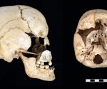 Ancient DNA reveals first prehistoric cases of Turner and Jacob's syndromes