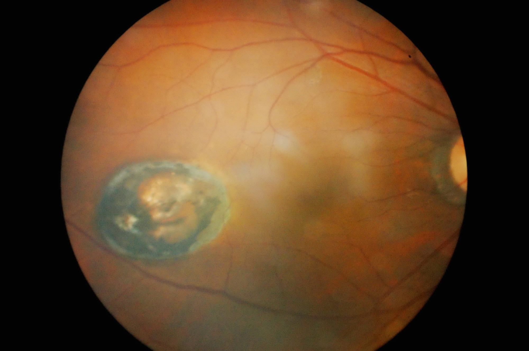 Study: Therapeutic targeting of cellular senescence in diabetic macular edema: preclinical and phase 1 trial results. Image Credit: Anukool Manoton / Shutterstock
