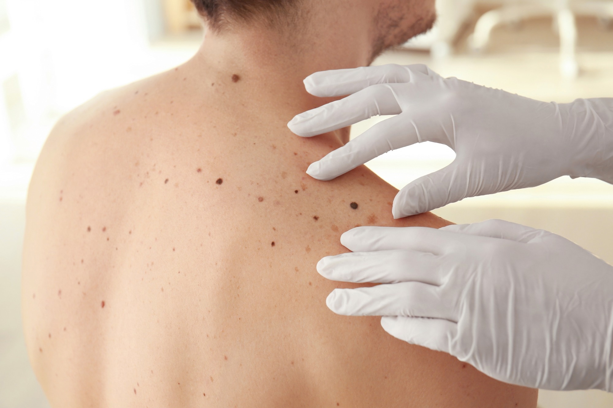 Study: Improving survival in advanced melanoma patients: a trend analysis from 2013 to 2021. Image Credit: Africa Studio/Shutterstock.com