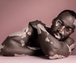 Diet's role in fighting vitiligo highlighted in new research