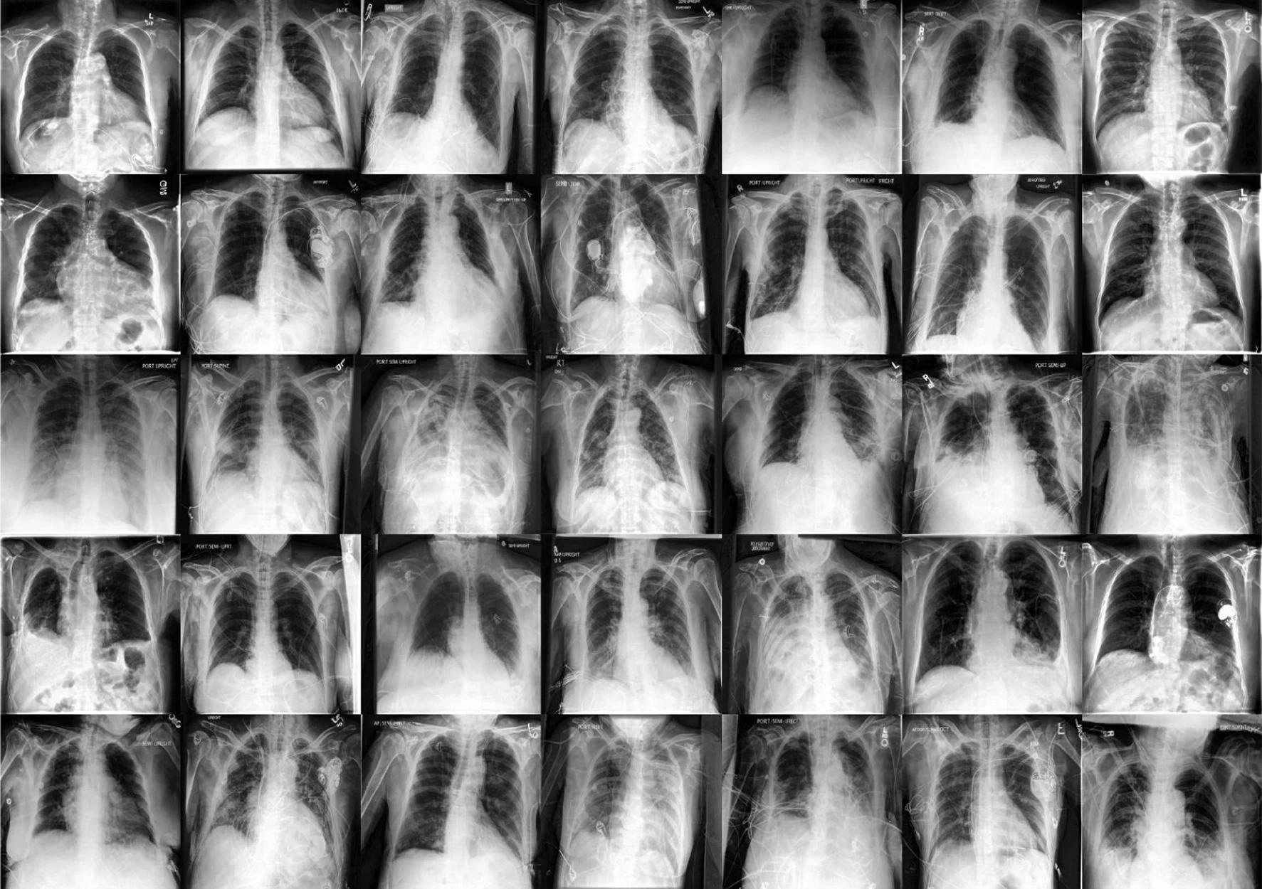 Study: Generative models improve fairness of medical classifiers under distribution shifts