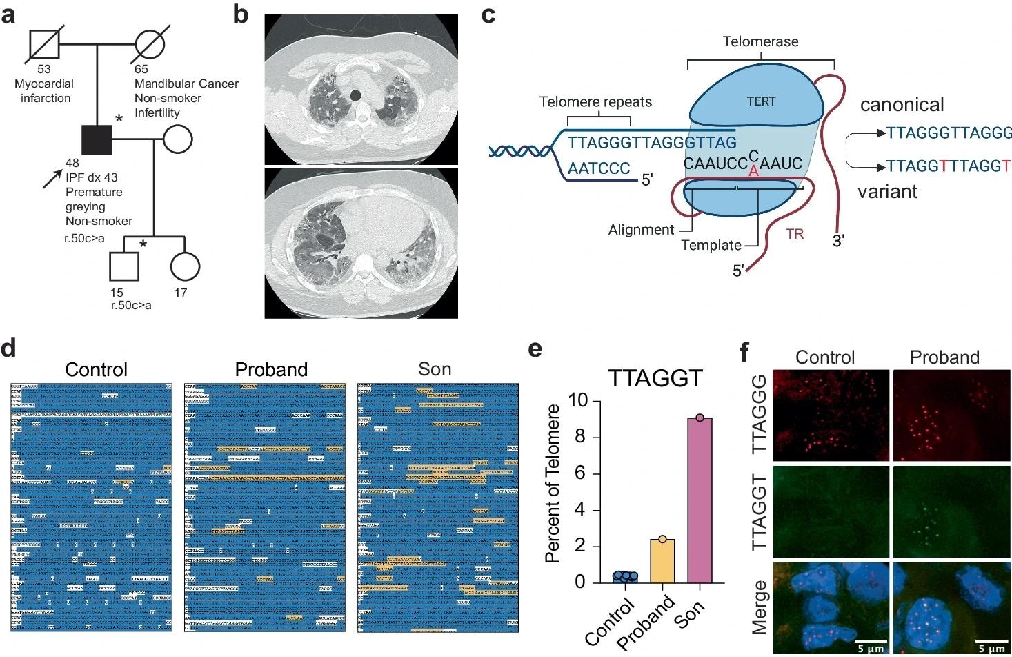 a Pedigree of the family carrying the TERC r.50 C > A variant. The proband (arrow) was diagnosed with IPF at age 43. Asterisks indicate individuals from which DNA was available. Squares indicate males and circles indicate females. A line through the symbol indicates the individual is deceased. b Apical (upper) and basal (lower) chest CT showing interstitial changes and advanced fibrosis in the proband before lung transplantation. c Graphic showing the location of the patient-derived variant in the template of TR and the resulting telomere sequence. Figure was created with BioRender.com and released under a Creative Commons Attribution-NonCommercial-NoDerivs 4.0 international license. d Excerpts of telomeric sequences from whole genome sequencing of an individual with no template mutation, the proband, and the proband’s son. Canonical repeats are highlighted in blue, variant TTAGGT repeats are highlighted in yellow, additional non-canonical sequences are in white. e The percentage of TTAGGT repeats in controls, the proband, and the proband’s son. f PNA-FISH for wild-type (red) and variant (green) sequence in a tissue section of the proband’s explanted lung and a control donated lung. Source data for (e) is provided as a Source Data file.