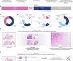 AI model Virchow outperforms clinical methods in cancer detection