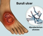 Study suggests mosquitoes as potential vectors for Buruli ulcers in Australia