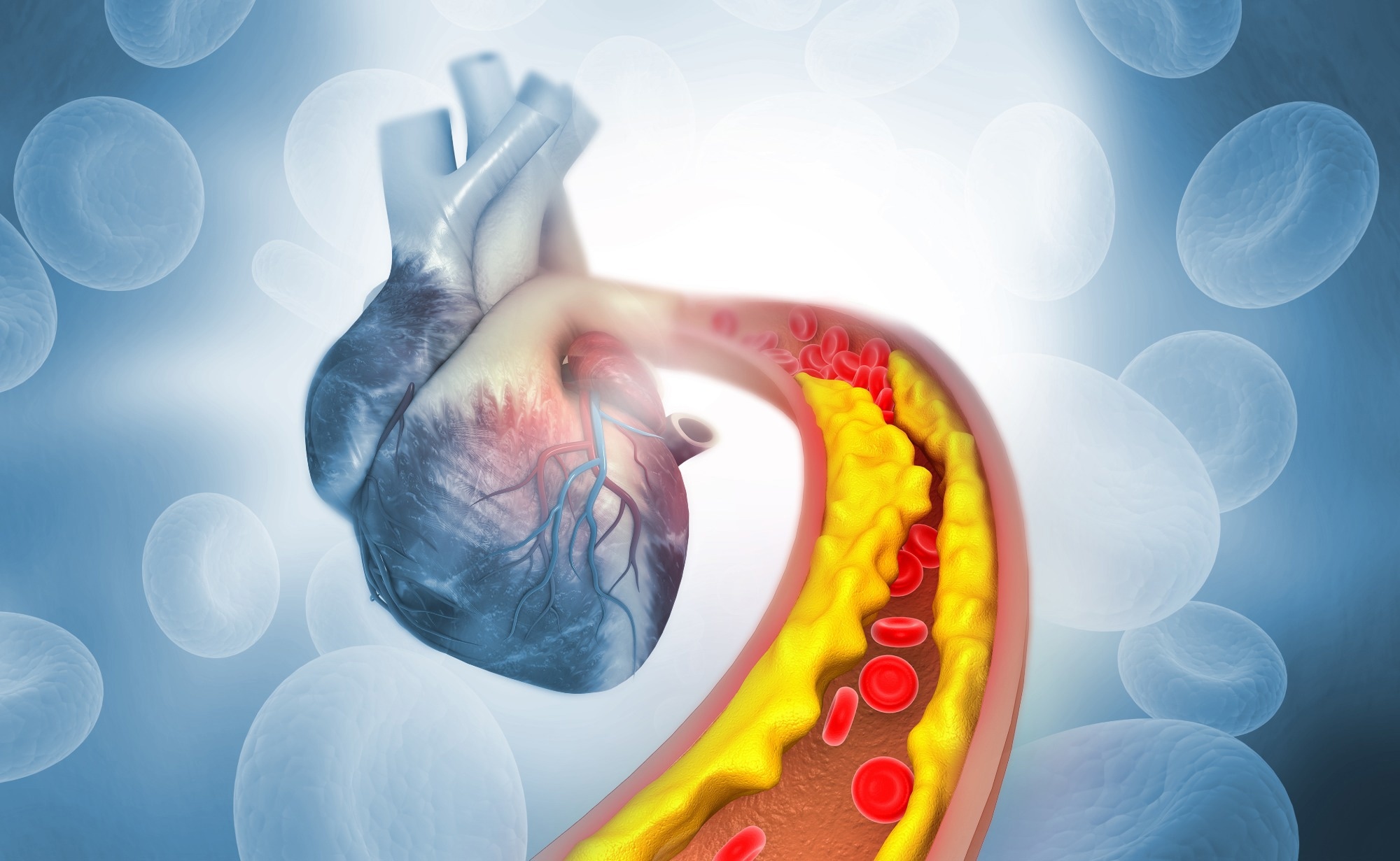 Study: Unidirectional association of clonal hematopoiesis with atherosclerosis development. Image Credit: Explode / Shutterstock