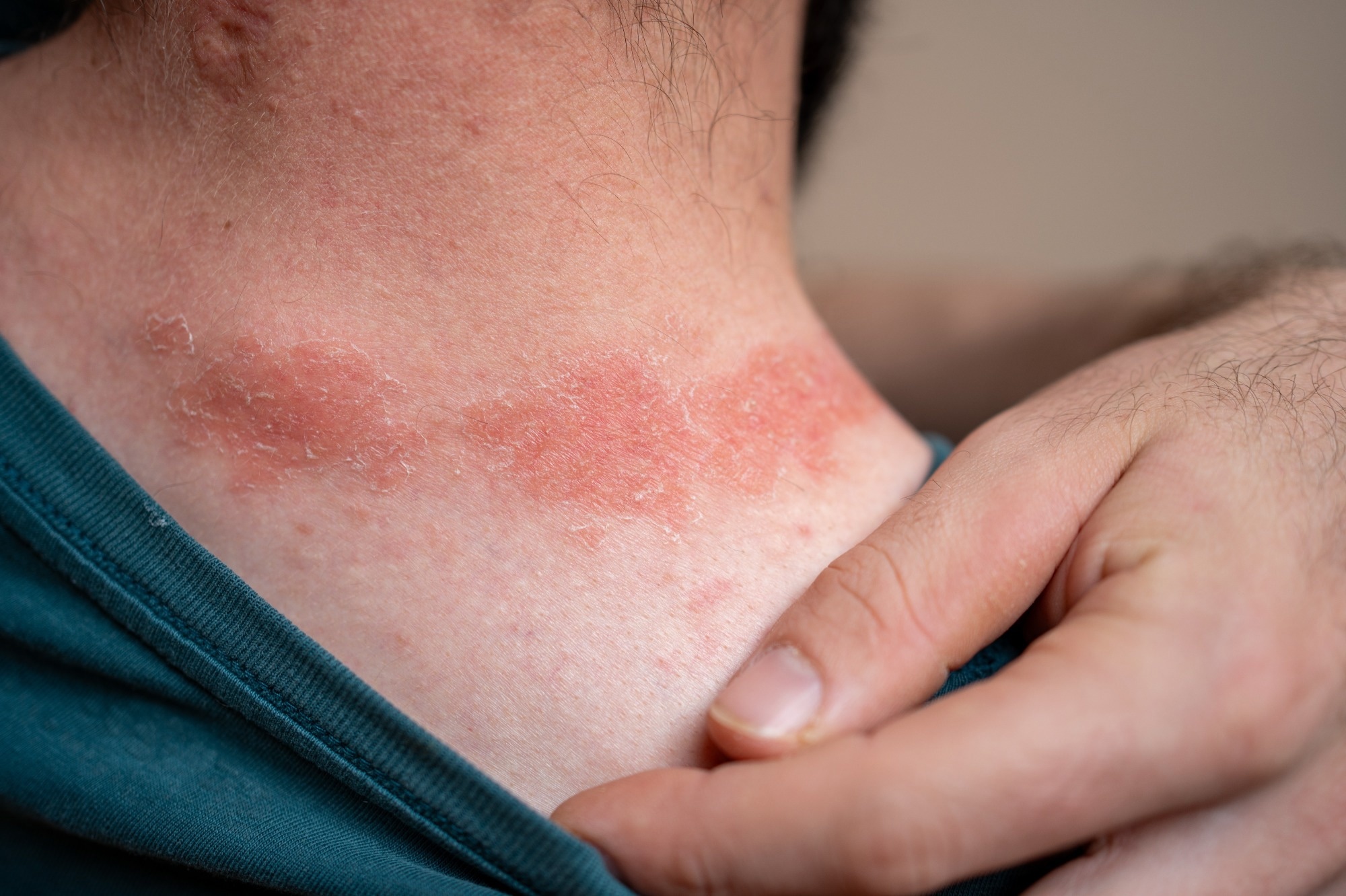 Study: Skin hepcidin initiates psoriasiform skin inflammation via Fe-driven hyperproliferation and neutrophil recruitment. Image Credit: Alan Mazzocco/Shutterstock.com