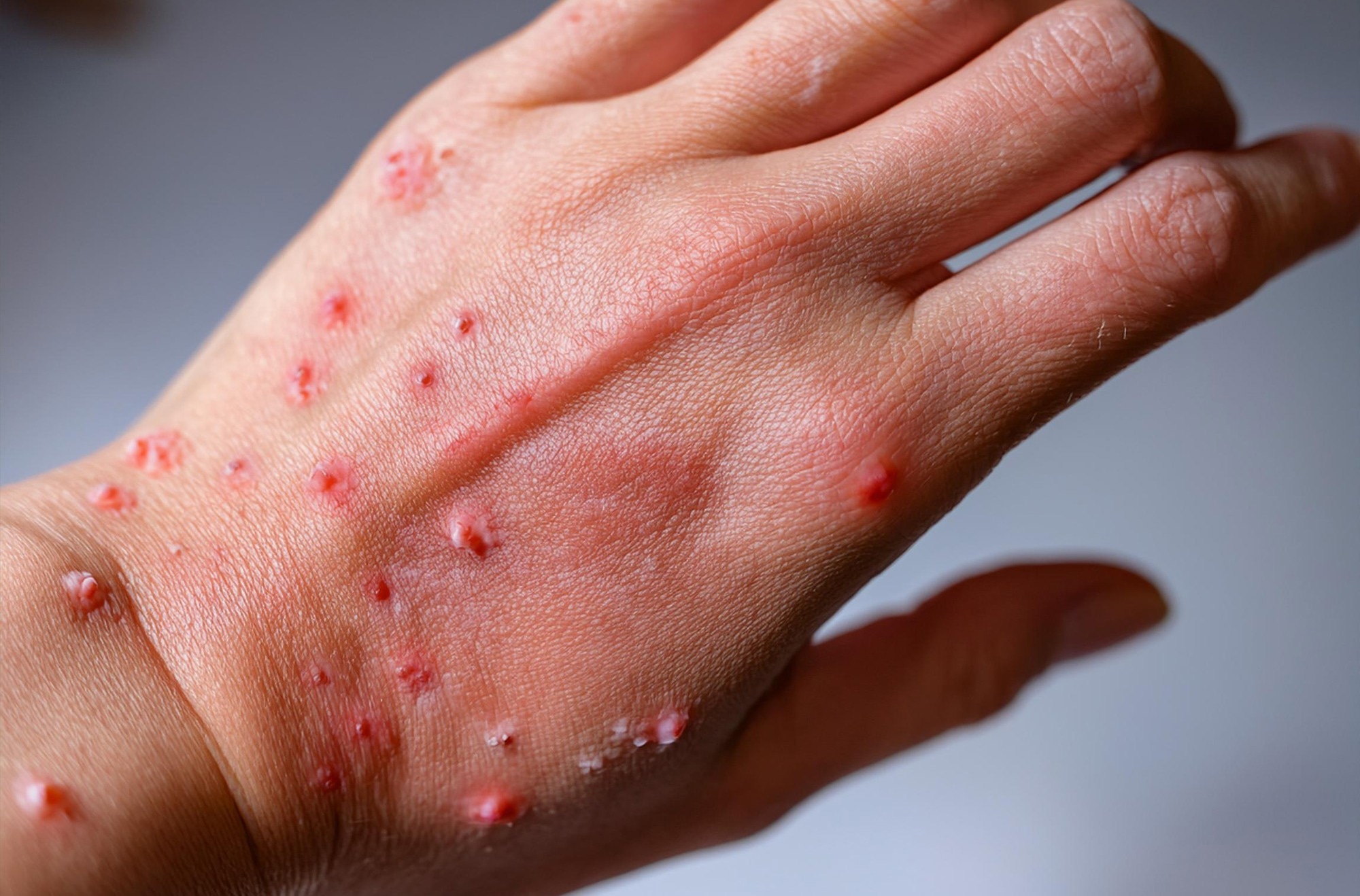 ​​​​​​​Study: Mpox Clinical Presentation, Diagnostic Approaches, and Treatment Strategies. Image Credit: karacacennet/Shutterstock.com