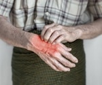 Heated mittens show promise in easing osteoarthritis pain and stiffness