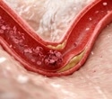 Researchers identify a natural defense against blood vessel inflammation and atherosclerosis
