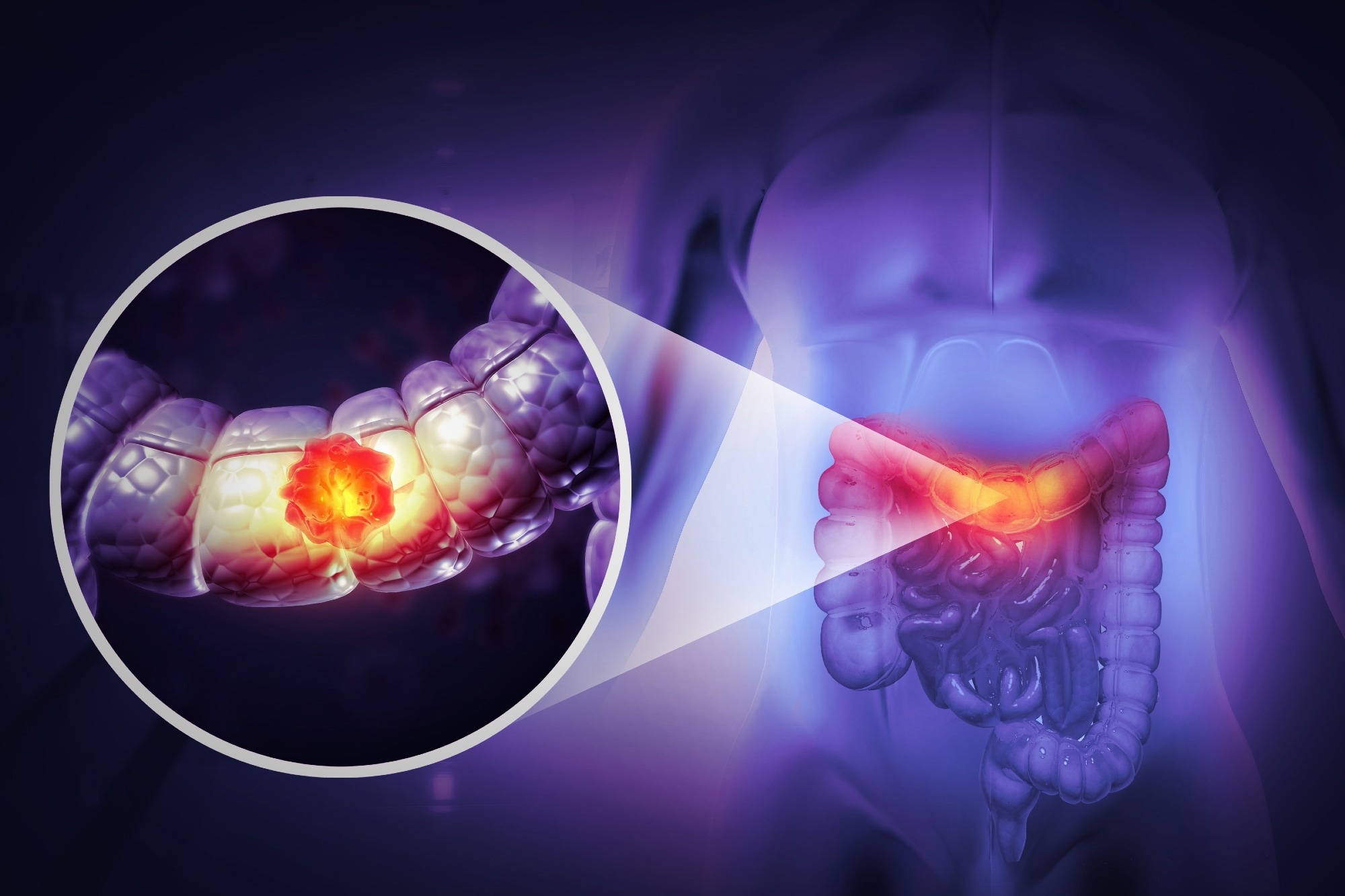 Study: Vitamin D and Colorectal Cancer Prevention: Immunological Mechanisms, Inflammatory Pathways, and Nutritional Implications. Image Credit: crystal light / Shutterstock.com