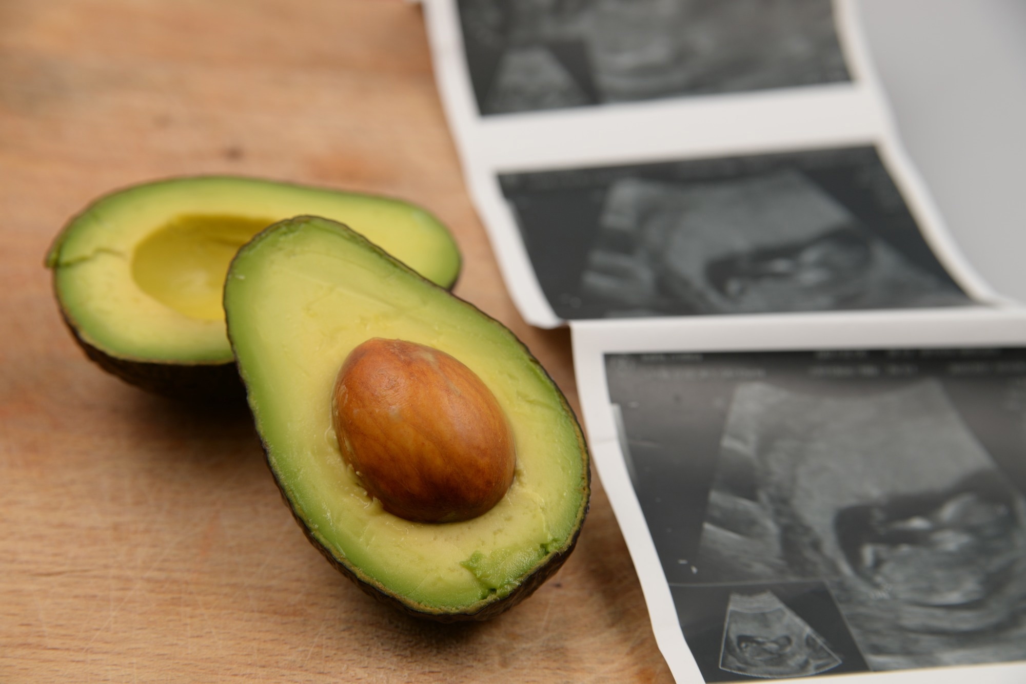 Study: Avocado consumption during pregnancy linked to lower child food allergy risk: prospective KuBiCo study. Image Credit: Cristina Indrie / Shutterstock