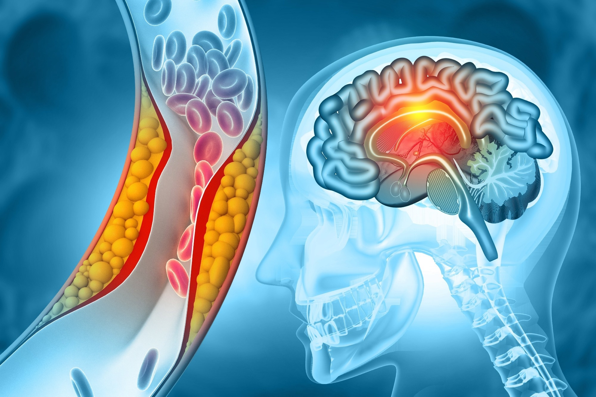 Study: Inhibition of GAPDH aggregation as a potential treatment for acute ischemic stroke. Image Credit: crystal light / Shutterstock