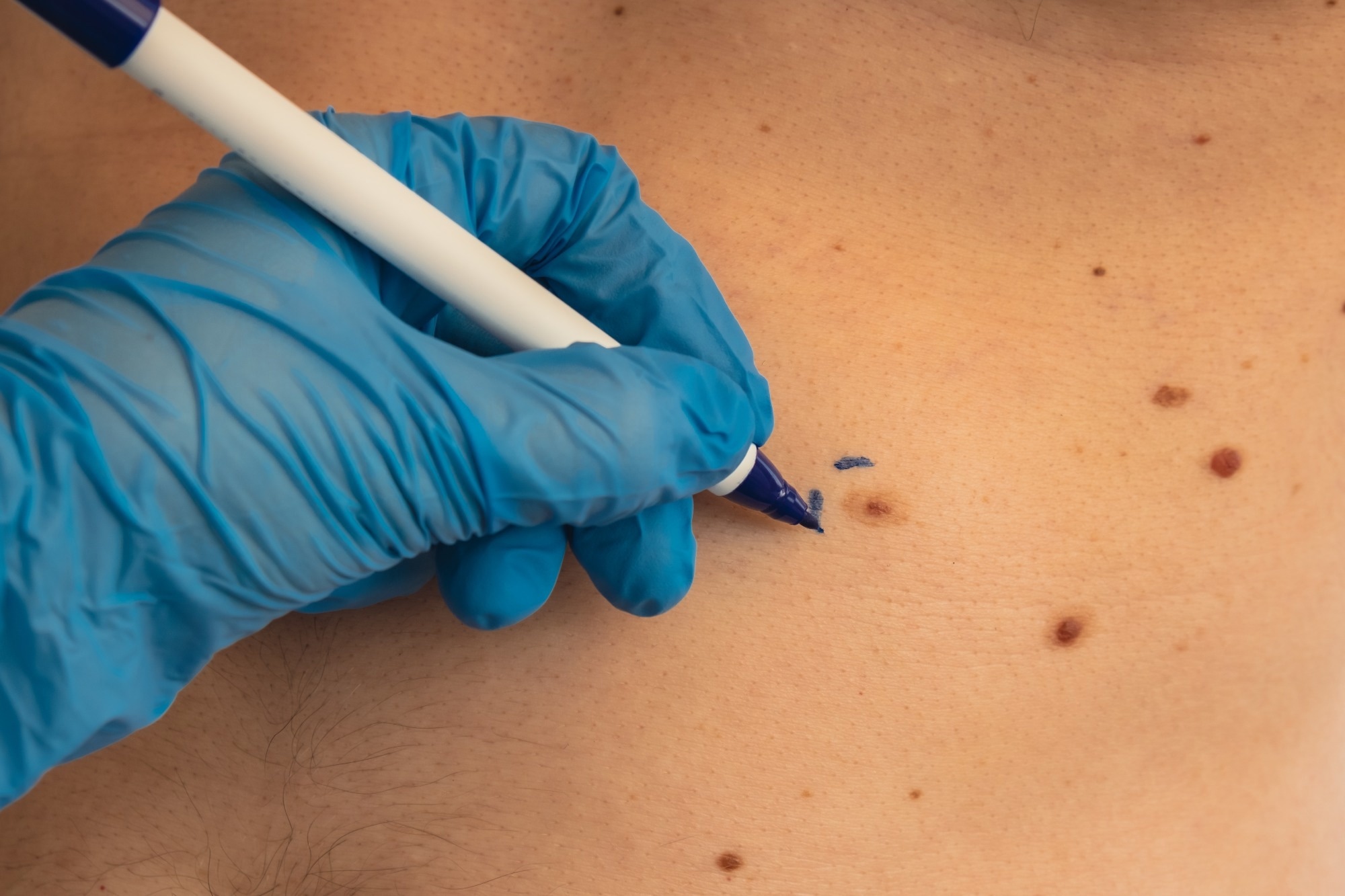 Study: Nicotinamide for Skin Cancer Chemoprevention. Image Credit: yanishevska / Shutterstock