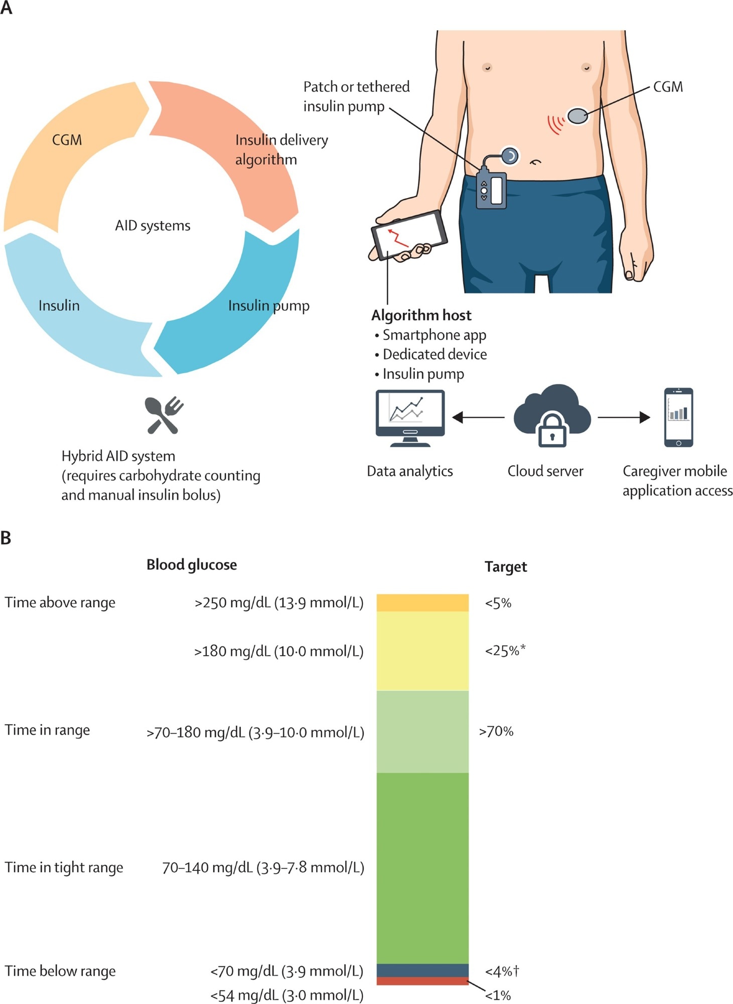AID systems and CGM-based glycaemia targets (A) AID system with its connected components. Insulin dose is calculated on the basis of CGM values using an insulin delivery algorithm, and insulin is infused by the insulin infusion pump (tethered or patch pump). Dual-hormone systems (investigational and not depicted in the figure) infuse other hormones such as glucagon in addition to insulin. Hybrid AID requires meal-time carbohydrate counting and meal bolus input. CGM and insulin delivery data are uploaded to the cloud server for data analytics and can be accessed by parents, caregivers, and clinicians of people with diabetes. (B) Percentage of readings and time per day within target glucose range, time below target glucose range, time above target glucose range, and time in tight range.