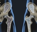 Routine blood test may flag hidden osteoporosis risk, study finds