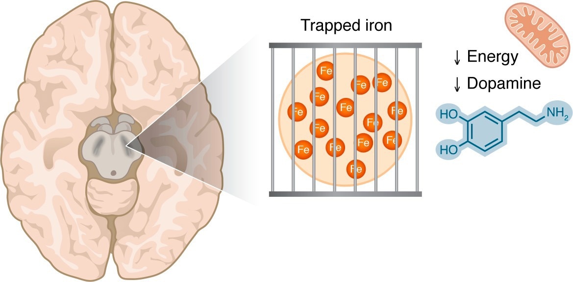 Iron accumulation in the substantia nigra is visible by MRI techniques in patients with PD. This iron may be in a trapped form, making it unavailable for the iron-dependent biological processes that are critical in dopaminergic cells, including mitochondrial respiration and dopamine synthesis.