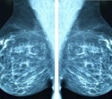 Minimal residual disease monitoring can transform breast cancer care