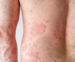 Novel treatment for inflammatory skin conditions could be on the horizon