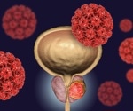 Common bladder infection may signal urogenital cancer risk