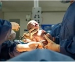 New research supports general anesthesia as an option for cesarean births