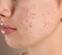 Study reveals widespread unrecognized acne among 35-year-old Finnish women
