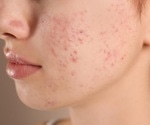 Unexpected benzene levels in popular acne and rosacea products