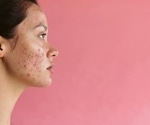 Individuals with acne face stigmatizing attitudes from the general public, study finds
