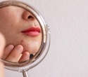 Study reveals widespread unrecognized acne among 35-year-old Finnish women
