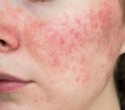 Study reveals widespread unrecognized acne among 35-year-old Finnish women