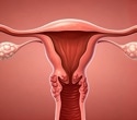 Modern pollutants and ancient genetic variants could explain why some women develop endometriosis