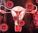 Modern pollutants and ancient genetic variants could explain why some women develop endometriosis