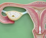 New menstrual blood test detects endometriosis with five times greater sensitivity